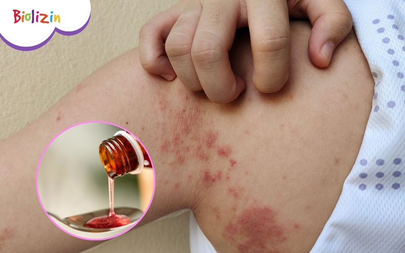 trẻ uống kẽm có bị nổi mụn không 1