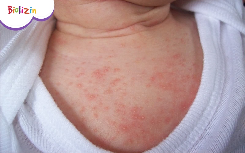 trẻ uống kẽm có bị nổi mụn không 2