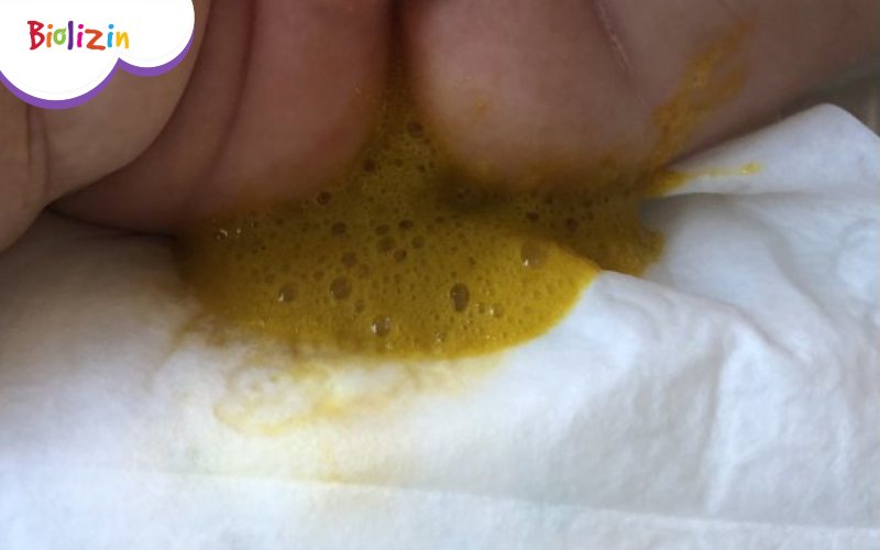 Hình ảnh đi ngoài phân sống ở trẻ 6